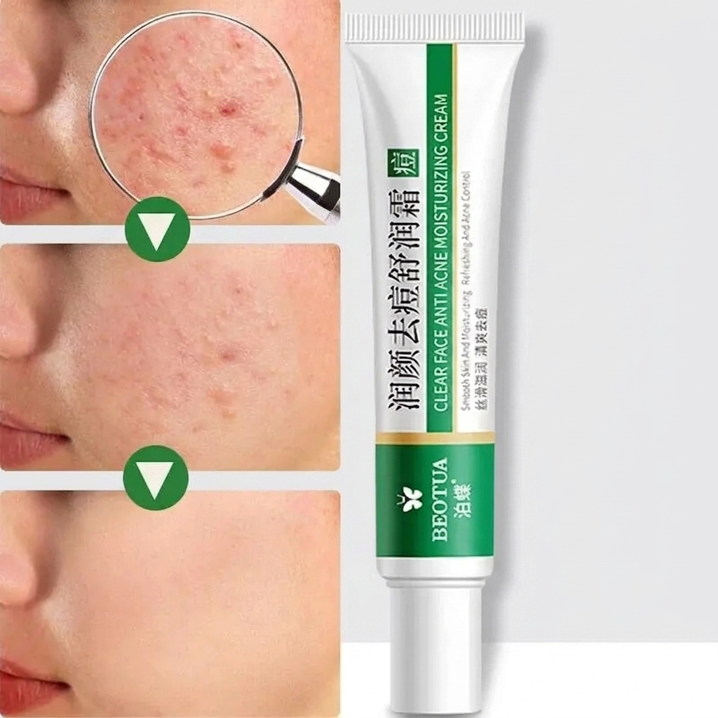 Crème hydratante anti-acné pour le visage